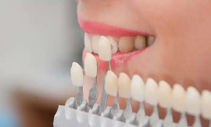 Enhancing Your Smile with Porcelain Veneers: Discover the Possibilities at Chamberlain Dental